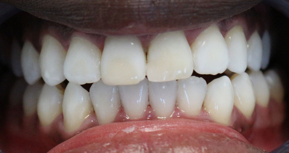 INVISALIGN houston