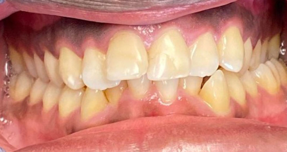 INVISALIGN dentist houston