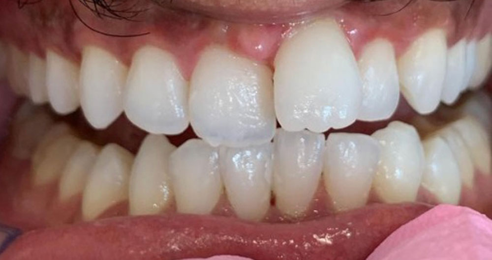 invisalign before and after