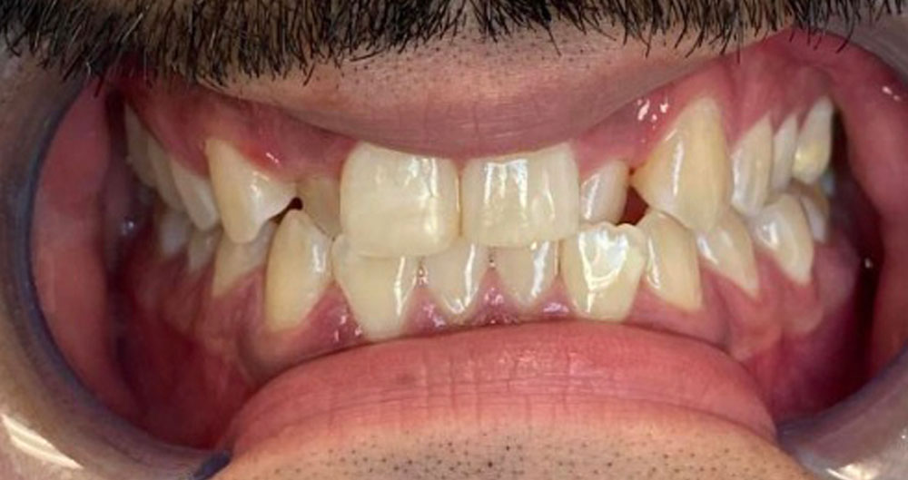 invisalign treatment near me
