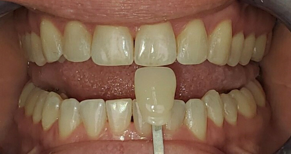 teeth whitening houston