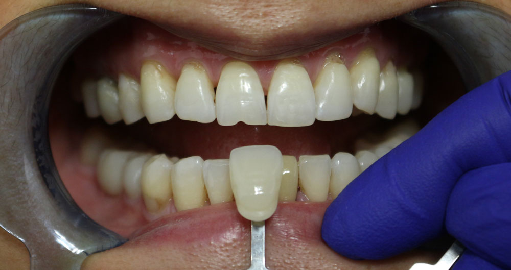 teeth whitening before and after