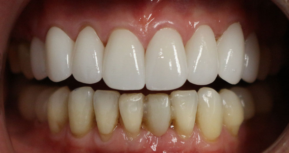 teeth veneers near me